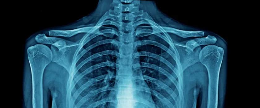 Sklerotyzacja stropu panewki - co to znaczy i jak wpływa na stawy?